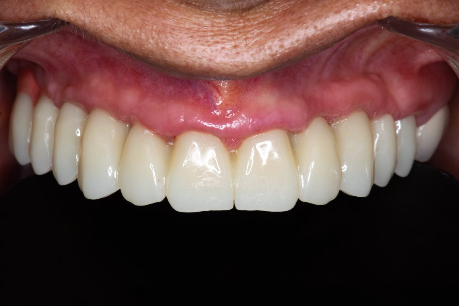 Resultado de rehabilitación con implantes dentales en la arcada superior
